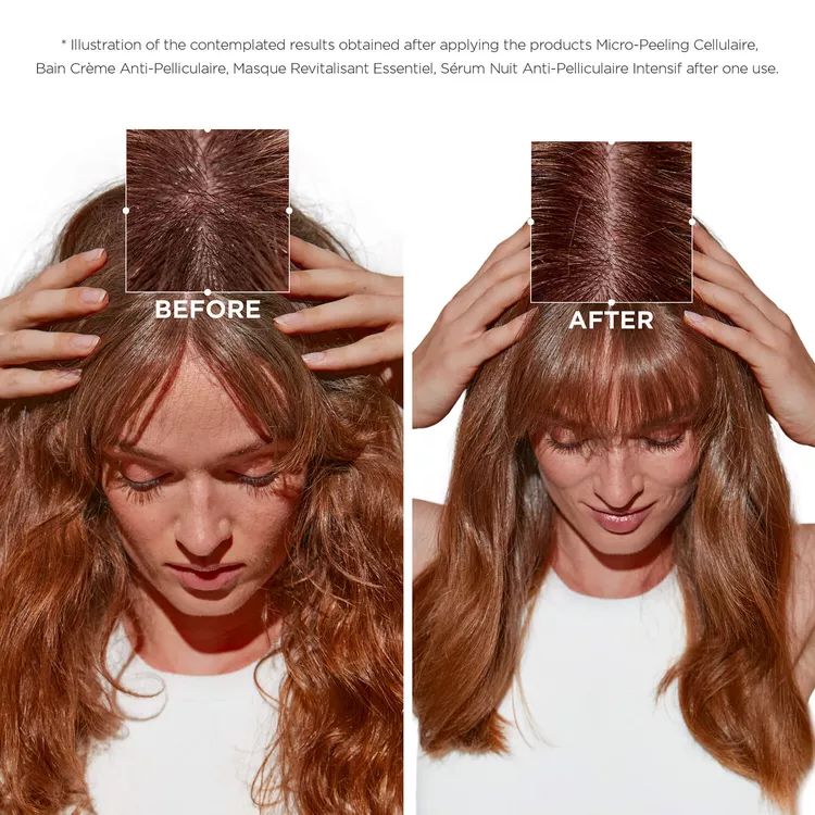 Symbiose Before and After to fight dandruff on oily scalp - Front